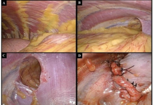 Thoracoscopy procedure images